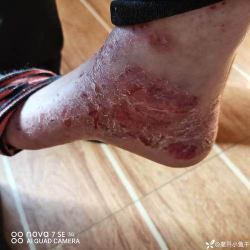 双鱼癫是什么病_双鱼癫早期症状有哪些